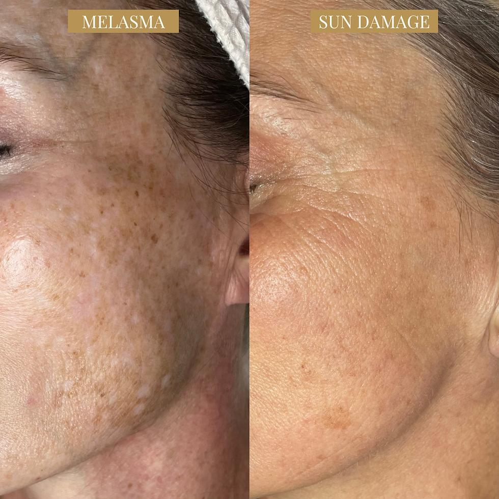 melasma vs sun damage 